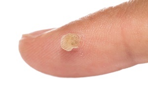 Une verrue est une maladie de peau, avec qui lutte efficacement Skincell Pro