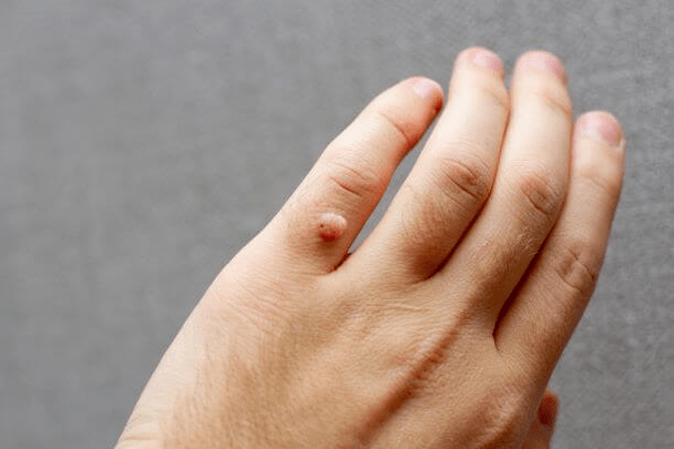 Virus du papillome humain sur le bras
