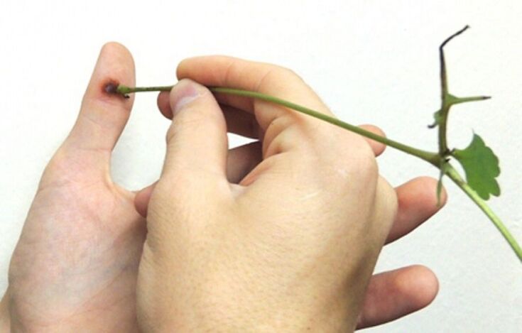 Utilisez du jus d'herbe de chélidoine pour éliminer les verrues des doigts