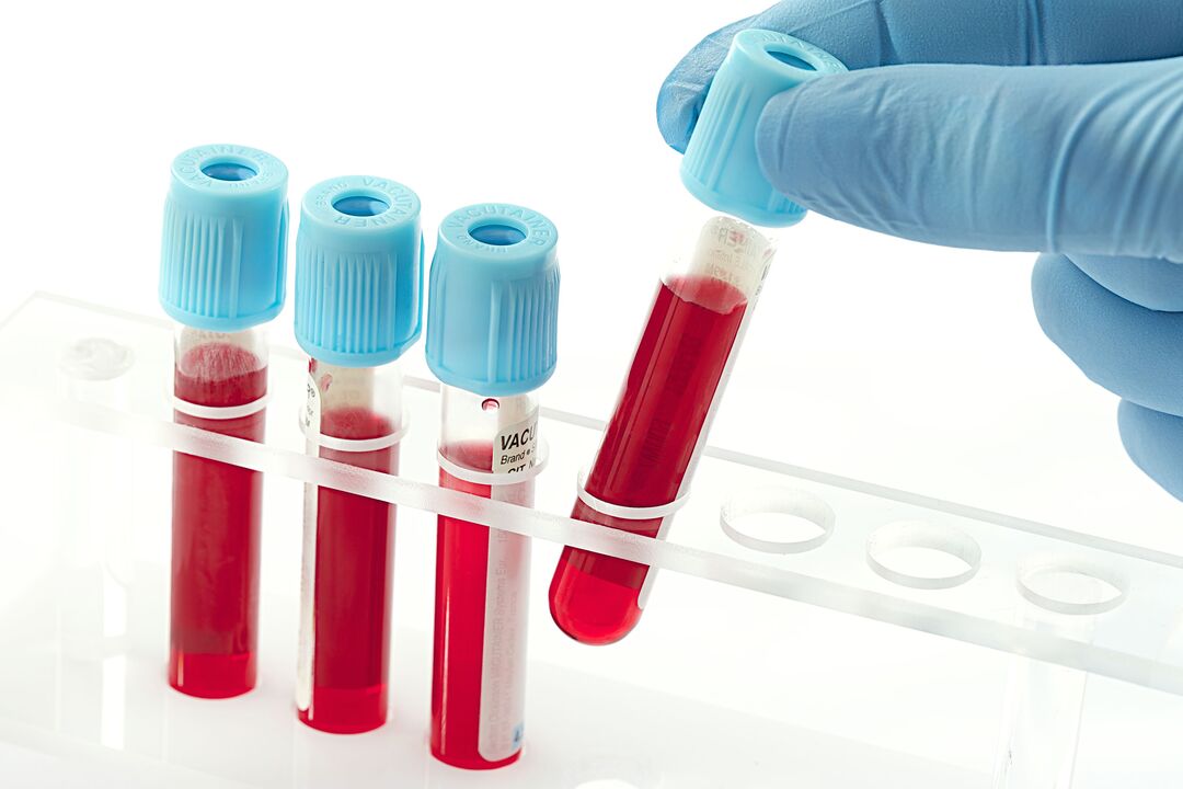 Des tests sanguins pour diagnostiquer le papillomavirus humain